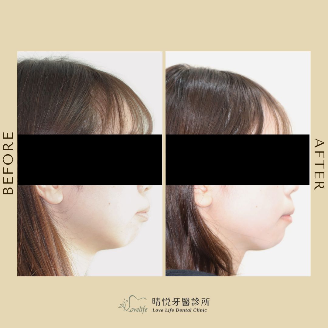 台中晴悦牙醫隱適美案例5-側面外觀前後對比照