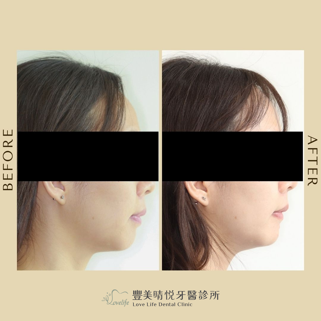 台中豐美晴悦牙醫隱適美案例6-側面外觀前後對比照